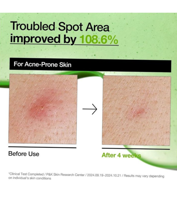 Anua – Azelaic Acid 10 Hyaluron Redness – Siero viso lenitivo anti-rossori