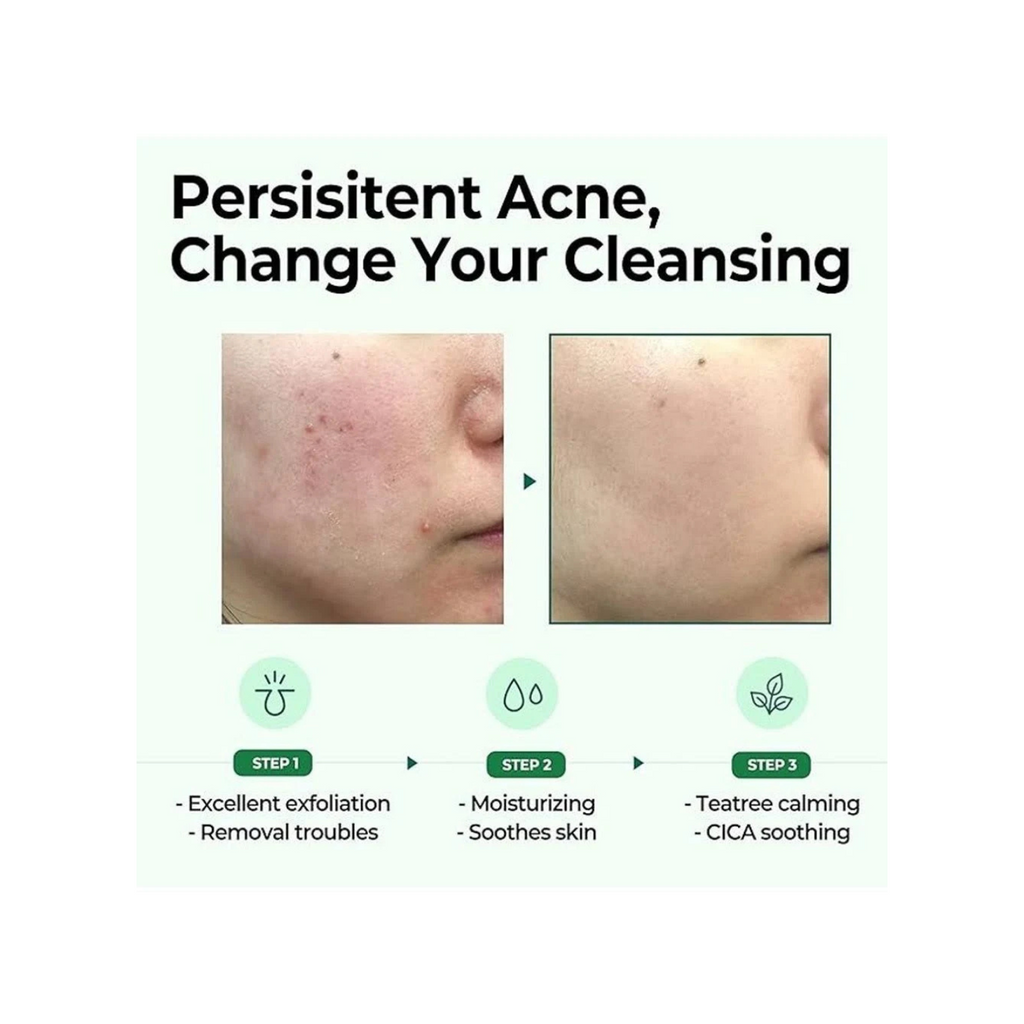 Some By Mi - AHA, BHA, PHA 30 Days Miracle Cleansing Bar - Sapone viso solido anti-acne