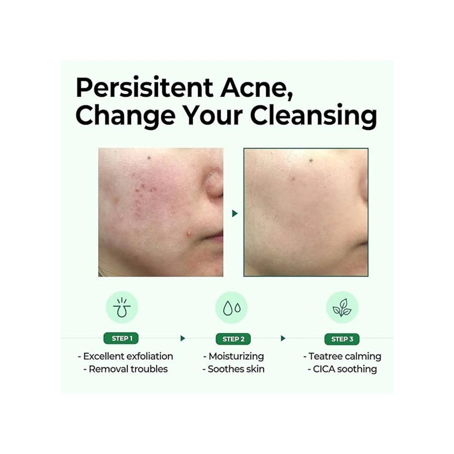 Some By Mi - AHA, BHA, PHA 30 Days Miracle Cleansing Bar - Sapone viso solido anti-acne