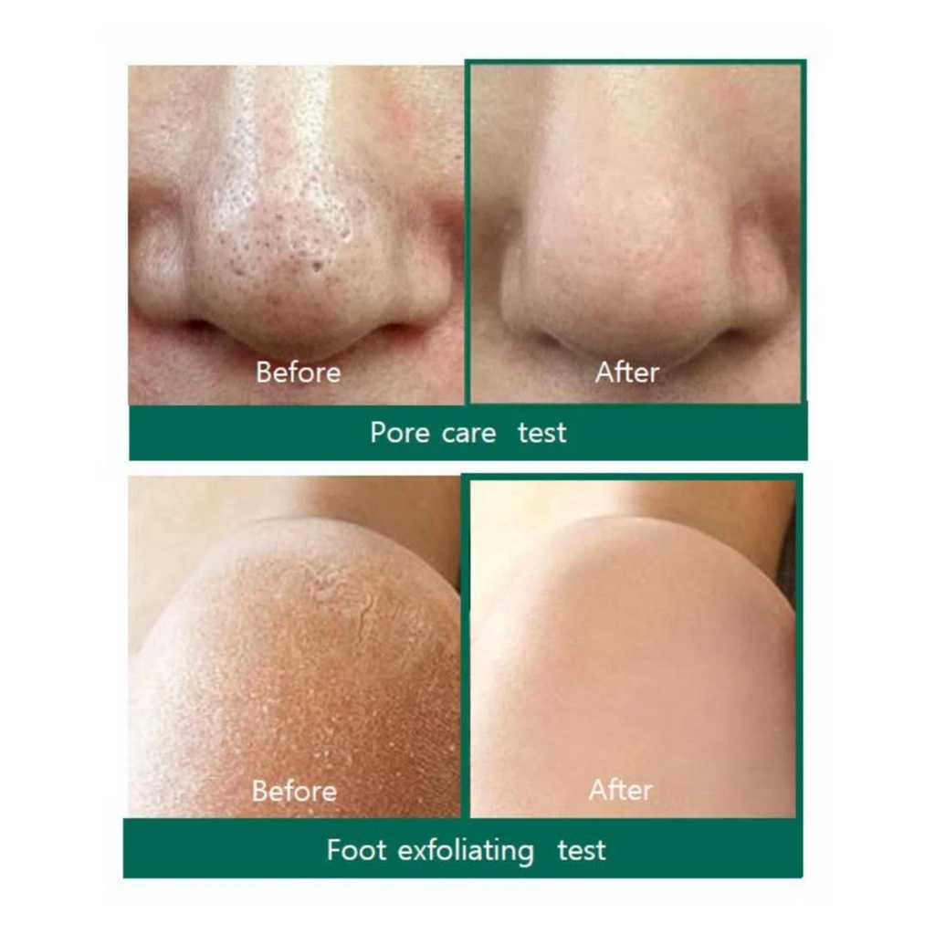 Some By Mi - AHA, BHA, PHA 30 Days Miracle Cleansing Bar - Sapone viso solido anti-acne