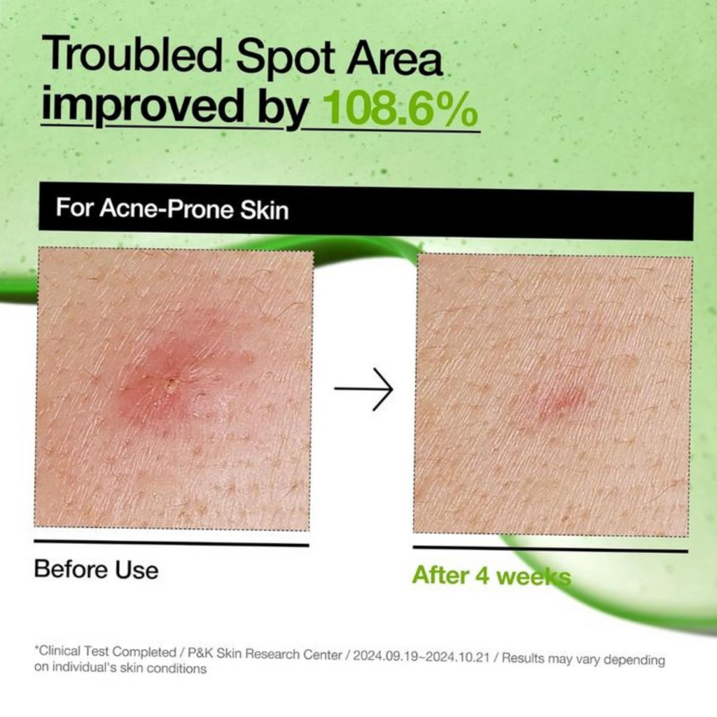 Anua – Azelaic Acid 10 Hyaluron Redness Soothing Serum – Siero viso lenitivo anti-rossori